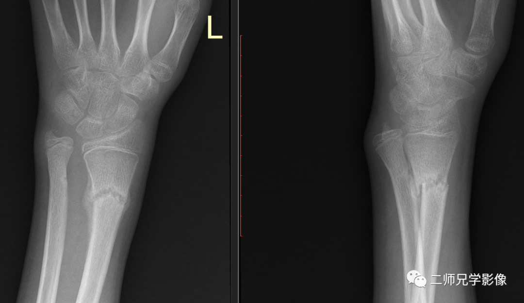 怎么取放射片放射拍片中的“几何学”，临床医生和技师都掌握了吗？_https://www.jmylbn.com_新闻资讯_第10张