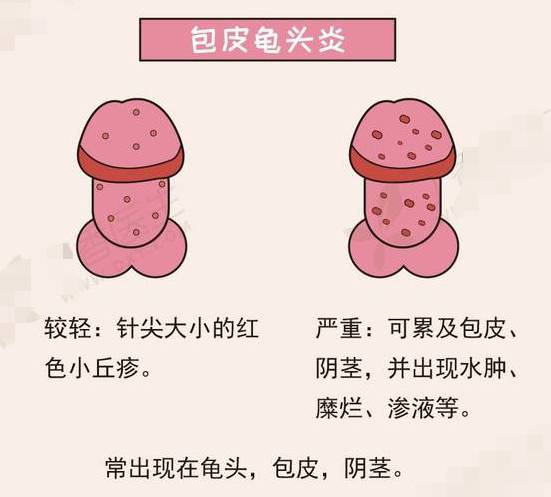 与丁丁头的炎症,正常包皮腔内分泌的一种类脂物质,在包皮过长或包茎时