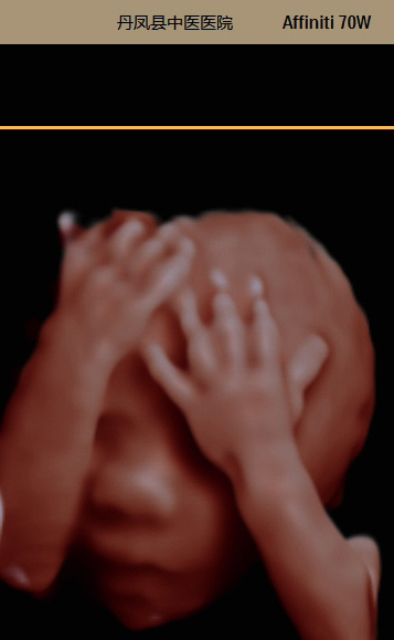 彩超伪像是什么读懂“B超”——无创影像之超声检查_https://www.jmylbn.com_新闻资讯_第5张