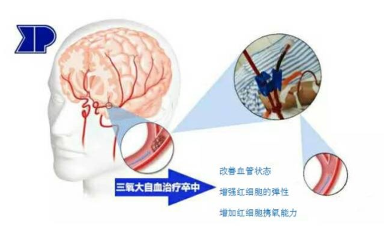 三氧治疗什么【科普】医用三氧自血疗法_https://www.jmylbn.com_新闻资讯_第2张