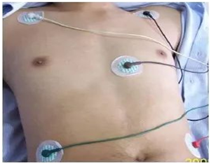 心电遥测怎么戴监护心脏的“哨兵”-无线遥测心电监护系统_https://www.jmylbn.com_新闻资讯_第10张