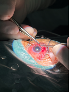 怎么装青光眼眼睛里装“阀门”，摆脱难治性青光眼困扰！_https://www.jmylbn.com_新闻资讯_第7张