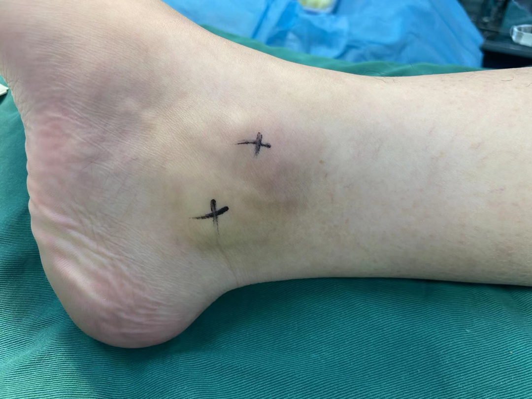 伤不起的踝关节痛——跟距骨桥 - 基层网