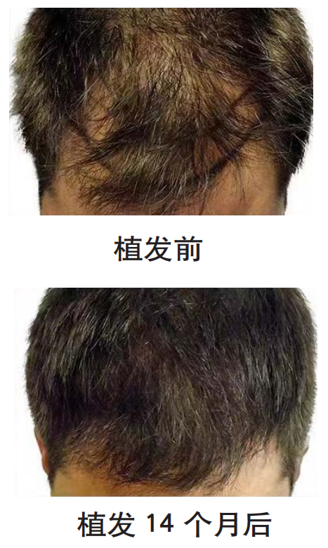 FUE怎么提取毛囊健康速递 ｜ 这件“头等大事”可以交给“机器人”，了解一下吧_https://www.jmylbn.com_新闻资讯_第4张