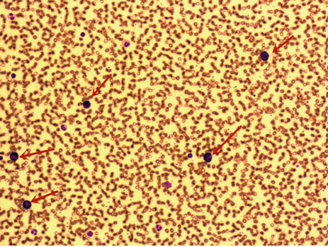 粪便常规仪器怎么用一场“大追踪”！引起嗜酸性粒细胞增高的真正原因是……_https://www.jmylbn.com_新闻资讯_第6张