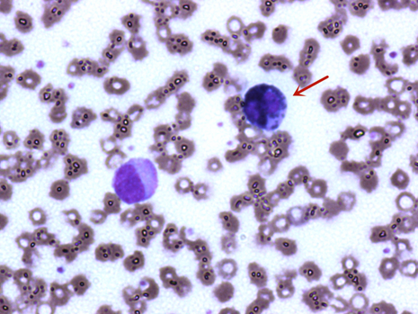 粪便常规仪器怎么用一场“大追踪”！引起嗜酸性粒细胞增高的真正原因是……_https://www.jmylbn.com_新闻资讯_第7张