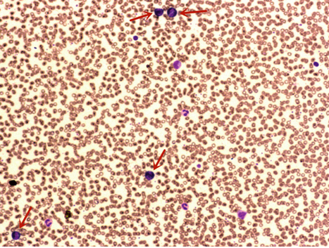 粪便常规仪器怎么用一场“大追踪”！引起嗜酸性粒细胞增高的真正原因是……_https://www.jmylbn.com_新闻资讯_第5张