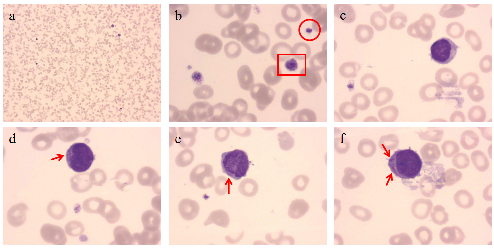 方框處為大血小板,圓圈處為正常大小的血小板;圖2c-2f早幼粒細胞,箭頭