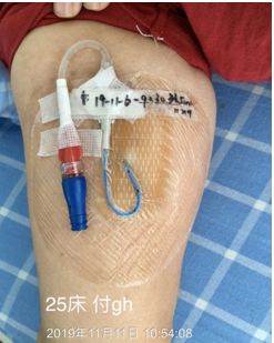 怎么撕敷料啊PICC：0°揭敷料，Ω固定法，好经验快收藏！_https://www.jmylbn.com_新闻资讯_第4张