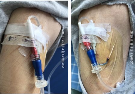 怎么撕敷料啊PICC：0°揭敷料，Ω固定法，好经验快收藏！_https://www.jmylbn.com_新闻资讯_第3张
