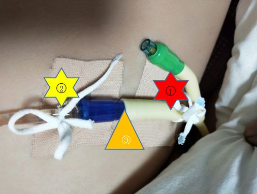 尿管怎么固定尿管固定别小看5cm，却是“血”的差距！_https://www.jmylbn.com_新闻资讯_第2张