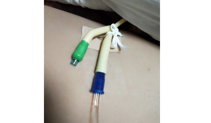 尿管怎么固定尿管固定别小看5cm，却是“血”的差距！_https://www.jmylbn.com_新闻资讯_第8张