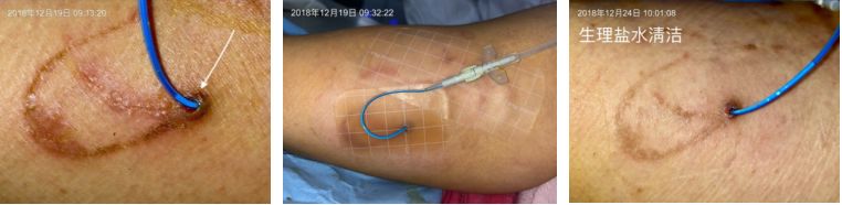 纱布敷料怎么用导管维护：先碘伏还是先酒精？敷贴2天还是7天一换？_https://www.jmylbn.com_新闻资讯_第3张