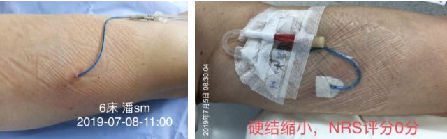 纱布敷料怎么用导管维护：先碘伏还是先酒精？敷贴2天还是7天一换？_https://www.jmylbn.com_新闻资讯_第6张