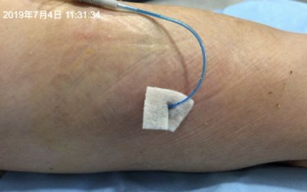 纱布敷料怎么用导管维护：先碘伏还是先酒精？敷贴2天还是7天一换？_https://www.jmylbn.com_新闻资讯_第5张