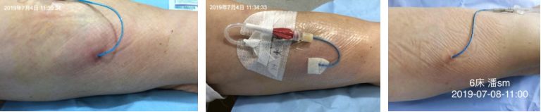 纱布敷料怎么用导管维护：先碘伏还是先酒精？敷贴2天还是7天一换？_https://www.jmylbn.com_新闻资讯_第2张