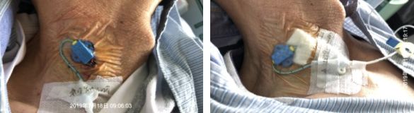 纱布敷料怎么用导管维护：先碘伏还是先酒精？敷贴2天还是7天一换？_https://www.jmylbn.com_新闻资讯_第7张