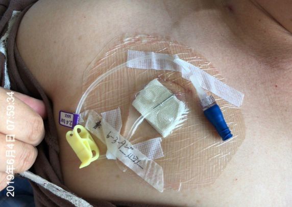 纱布敷料怎么用导管维护：先碘伏还是先酒精？敷贴2天还是7天一换？_https://www.jmylbn.com_新闻资讯_第8张