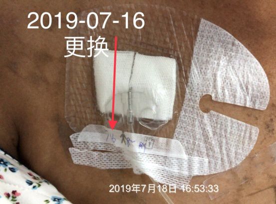 纱布敷料怎么用导管维护：先碘伏还是先酒精？敷贴2天还是7天一换？_https://www.jmylbn.com_新闻资讯_第9张