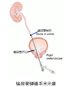 取石网篮 为什么贵【中心建设】泌尿肾病中心：拦截网篮，让结石无处遁行_https://www.jmylbn.com_新闻资讯_第3张