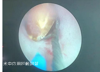 取石网篮 为什么贵【中心建设】泌尿肾病中心：拦截网篮，让结石无处遁行_https://www.jmylbn.com_新闻资讯_第7张