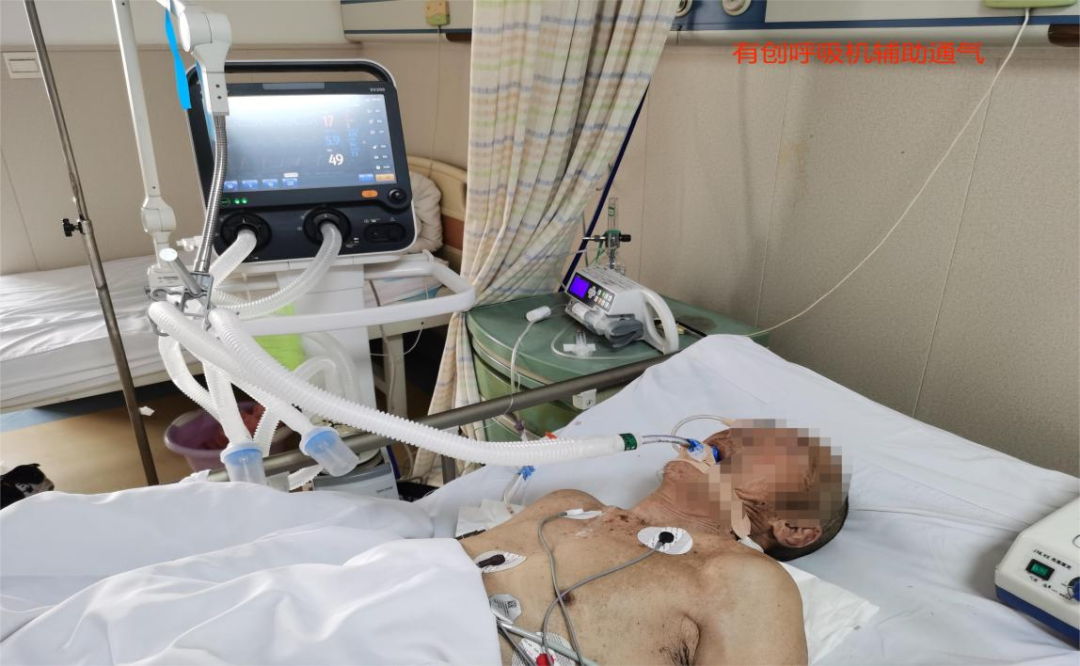 什么是有创呼吸机图片院区动态 ｜ 抢救生命，争分夺秒——泊里院区运用有创呼吸机成功抢救呼吸危重症患者_https://www.jmylbn.com_新闻资讯_第3张
