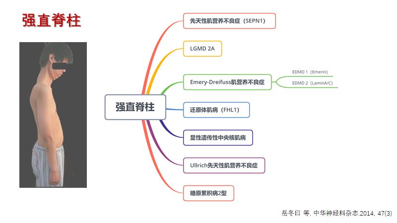 神经肌病的特殊体征 Hanson临床科研 微信公众号文章阅读 Wemp