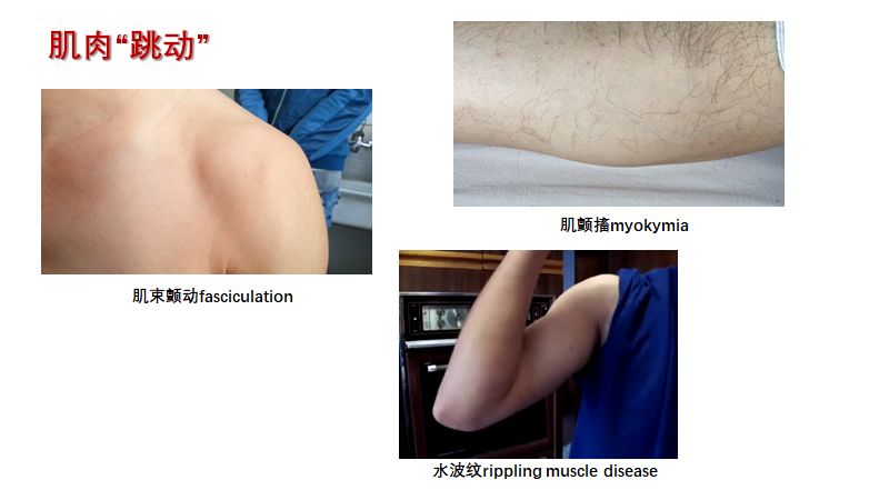 神经肌病的特殊体征 Hanson临床科研 微信公众号文章阅读 Wemp