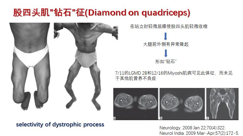 神经肌病的特殊体征 Hanson临床科研 微信公众号文章阅读 Wemp