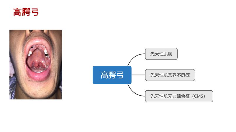 神经肌病的特殊体征 Hanson临床科研 微信公众号文章阅读 Wemp