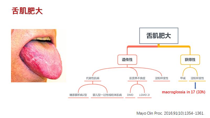 神经肌病的特殊体征 Hanson临床科研 微信公众号文章阅读 Wemp