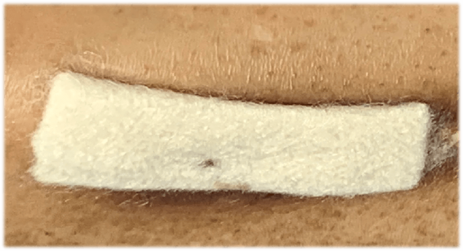 创面修复抗菌敷料怎么用【创面修复频道】伤口处理的基本原则。（聂邯洛医师推荐）_https://www.jmylbn.com_新闻资讯_第44张