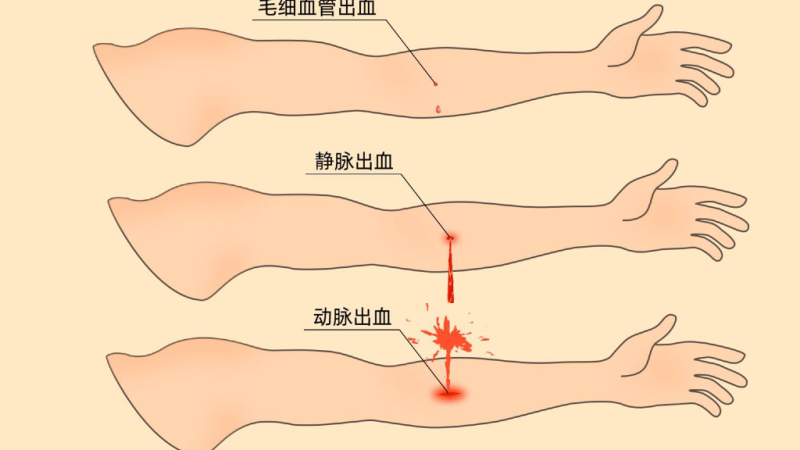 为什么要结扎血管【手术频道】手术结扎止血方法。（聂邯洛医师推荐）_https://www.jmylbn.com_新闻资讯_第8张