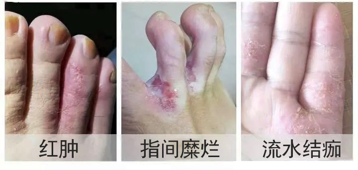 反复发作的手足癣有哪些种类？各自症状有何不同！