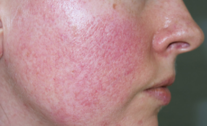 玫瑰痤疮的四种类型来看看你属于哪种