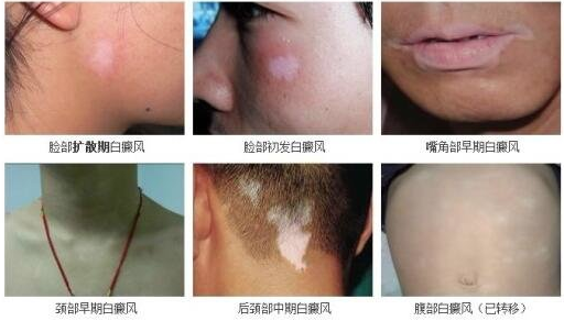 身上出现了白斑是得了白癜风吗