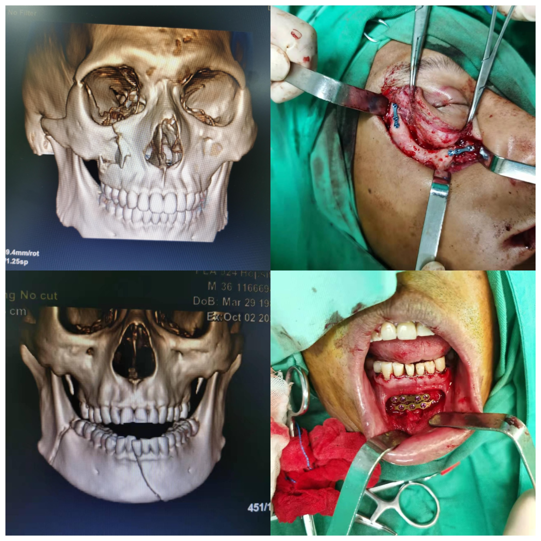口腔无痛麻醉仪怎么用优质学科速览——第924医院口腔科_https://www.jmylbn.com_新闻资讯_第10张