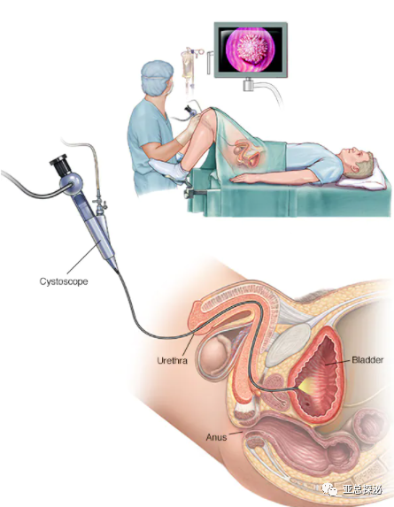 b膀胱镜为什么消毒膀胱镜检查知识及注意事项_https://www.jmylbn.com_新闻资讯_第2张