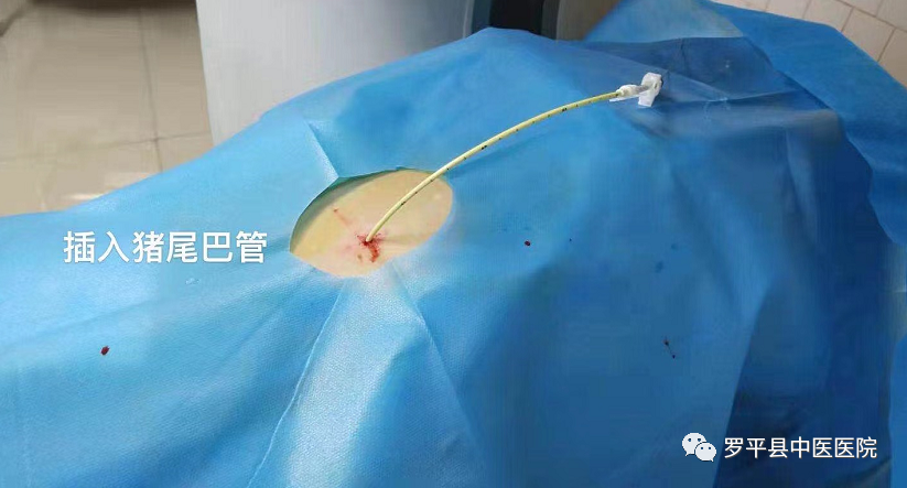 猪尾巴引流管是什么肺上插根“猪尾巴”？怎么回事？_https://www.jmylbn.com_新闻资讯_第5张