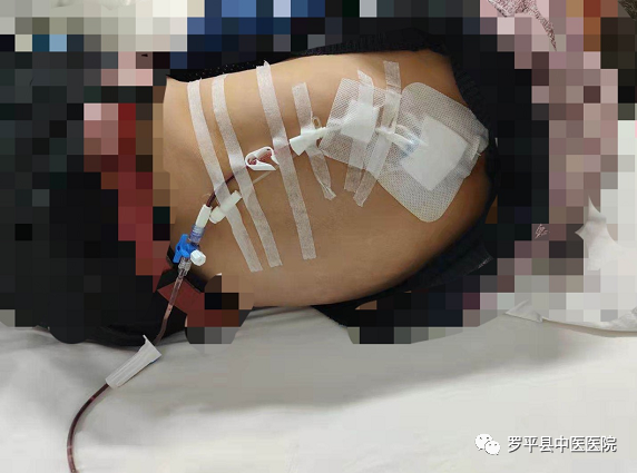 猪尾巴引流管是什么肺上插根“猪尾巴”？怎么回事？_https://www.jmylbn.com_新闻资讯_第6张