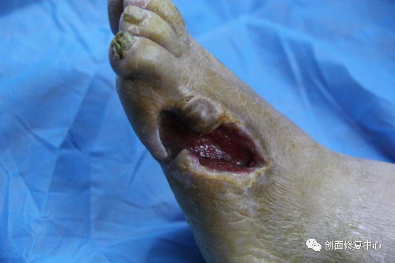 慢性创面综合诊疗 - 好大夫在线