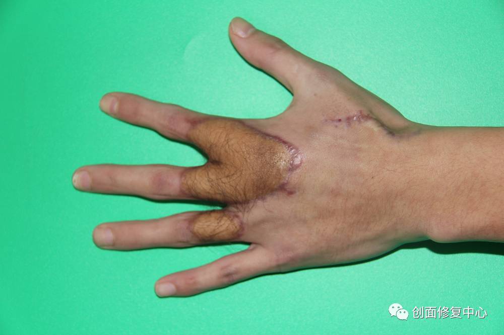 慢性创面综合诊疗 - 好大夫在线