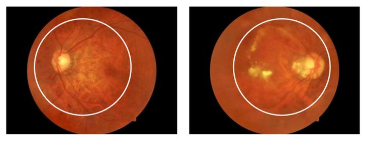 彩色眼底照相查什么拍一张眼底照片，就能帮你查清全身问题！_https://www.jmylbn.com_新闻资讯_第8张