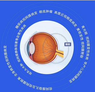 彩色眼底照相查什么拍一张眼底照片，就能帮你查清全身问题！_https://www.jmylbn.com_新闻资讯_第2张