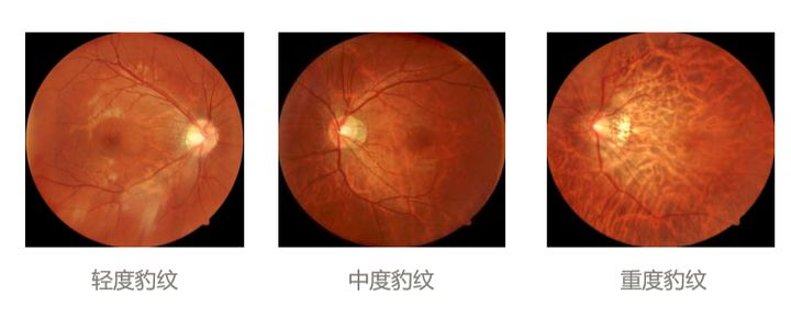 彩色眼底照相查什么拍一张眼底照片，就能帮你查清全身问题！_https://www.jmylbn.com_新闻资讯_第4张