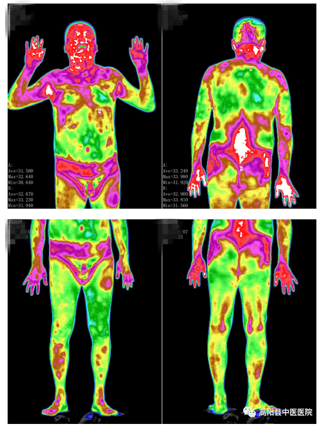 医用红外热像仪怎么开机【特色技术】我院引进红外热像仪，“一眼看穿”你的健康状况！_https://www.jmylbn.com_新闻资讯_第10张