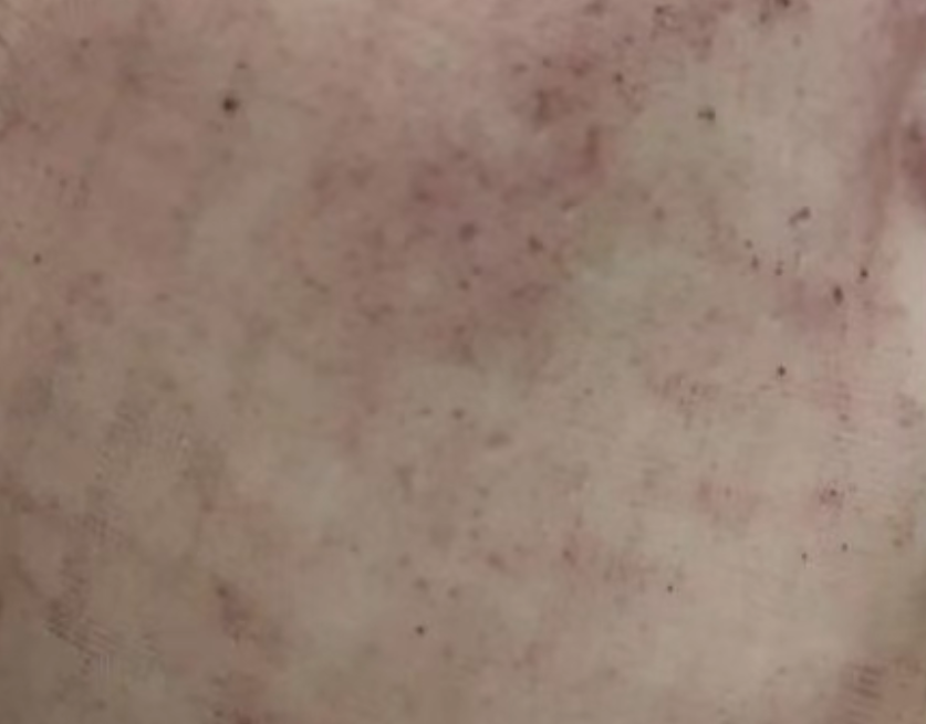 脸痘坑做了点阵激光要多少天结痂掉落