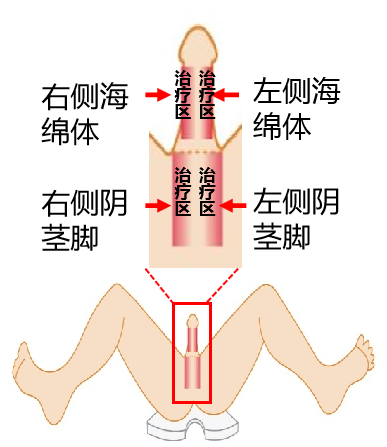 能量治疗器械有哪些勃起功能障碍先进治疗设备——以色列Renova体外线性冲击波治疗仪_https://www.jmylbn.com_新闻资讯_第3张