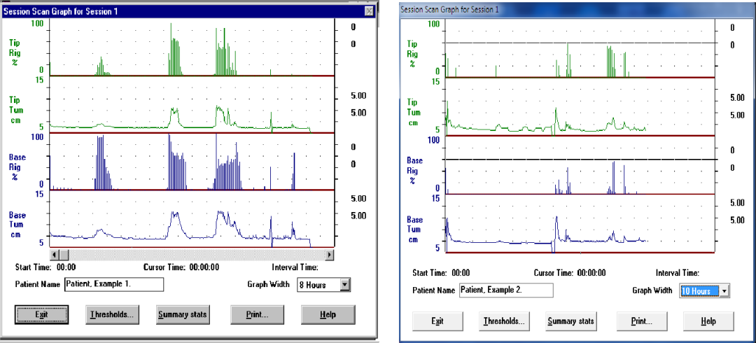 什么是性功能检测仪ED专用诊断设备—美国RigiScan阴茎硬度测量仪｜郑州博大医院_https://www.jmylbn.com_新闻资讯_第4张