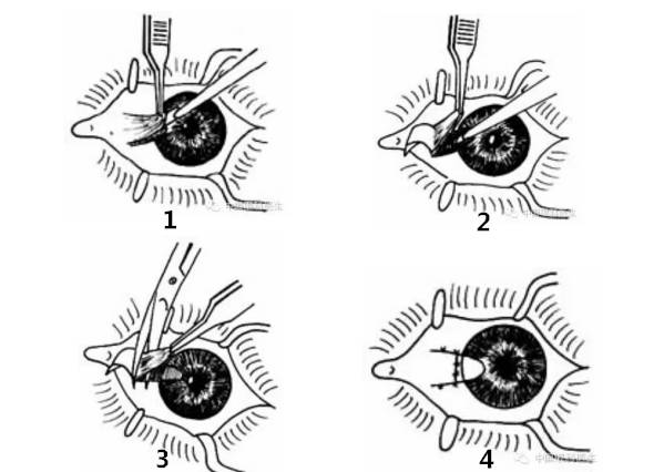 是目前国际上最新的治疗翼状胬肉的手术方法,适应于各种翼状胬肉及